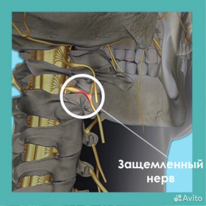 Защемление нерва в шейном отделе. Защемление нерва в шейном. Защемило нерв в позвоночнике.