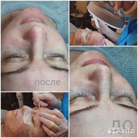 Комбинированная чистка лица