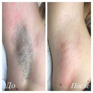 Электроэпиляция в Москве метро Серпуховская эпиляц